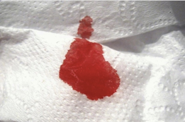 Кровь на туалетной бумаге — признак заболевания прямой кишки. Геморрой или опухоль?