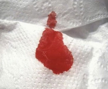 Кровь на туалетной бумаге